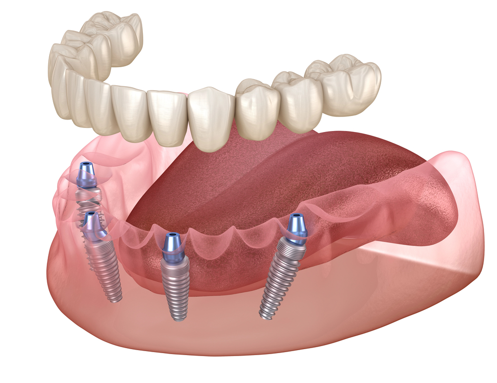 How All-On-4 Plus Implants Reengineer Stability in Modern Dentistry